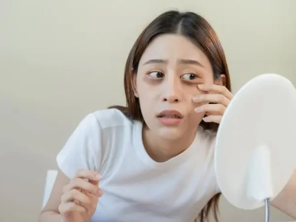 How to Treat Panda Eyes Easily